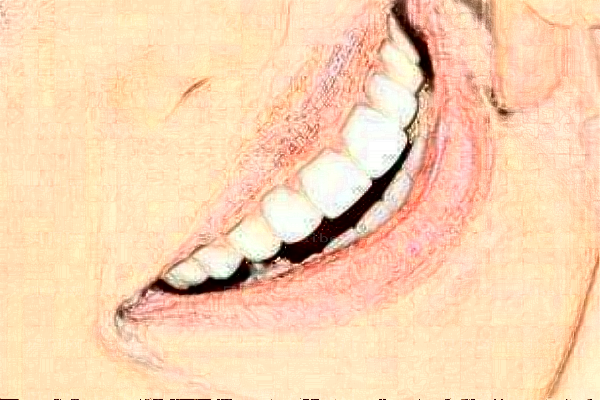 惠州精英惠口腔隐形矫正做的怎么样?隐形矫正谁做的好