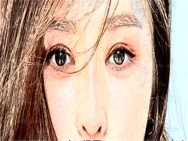 南关区久诺美开眼角做得好不好
