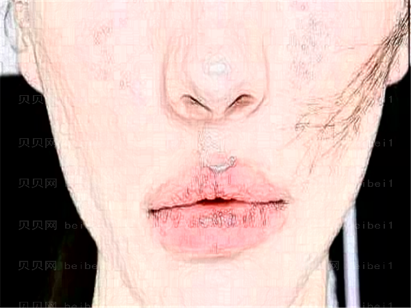 隆鼻会留疤吗?隆鼻恢复期要多久