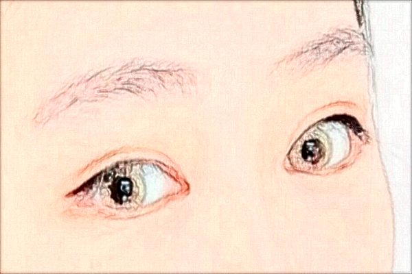 南昌韩美双眼皮整形价格一览?多久能恢复?