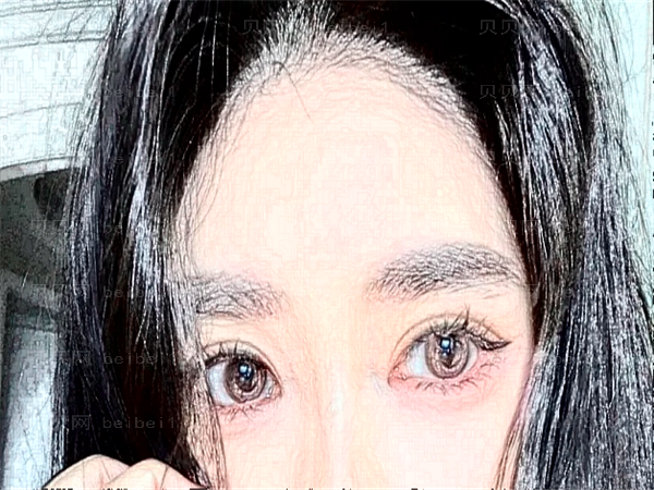杭州格莱美毛发种植贵不贵_毛发种植会脱落吗