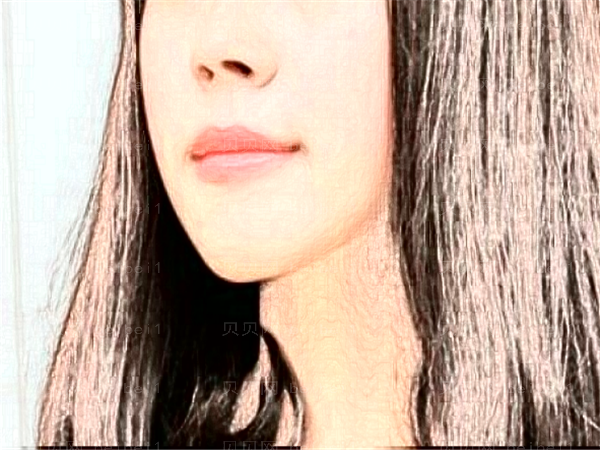 赣州华美厚唇改薄价格贵不贵?哪个医生做的好?