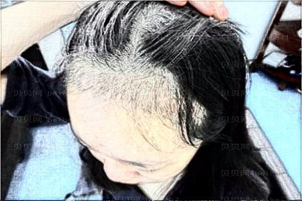北京碧莲盛植发整形价格一览!好的医生名单