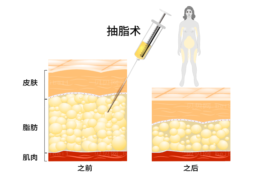 中山大腿环吸哪家医院好？吸脂手术多少钱？我怕做完之后凹凸不平