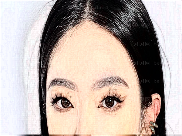 菏泽悦美自体脂肪丰眼窝怎么样?哪位医生做的好?