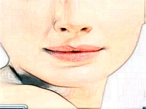 成都美乐雅假体取出做的好吗?会有后遗症吗?