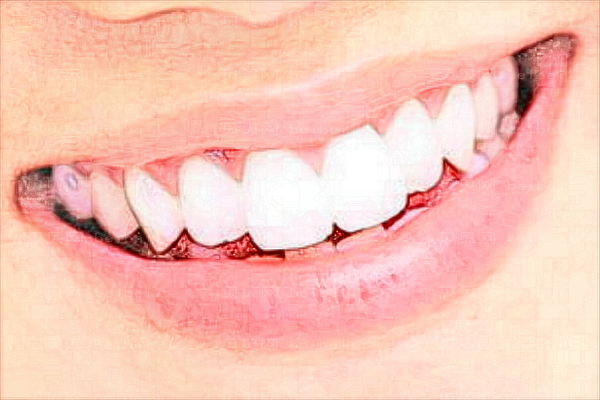佛山梦露医学美容门诊部M唇做的好吗?M唇手术大概多久可以恢复?