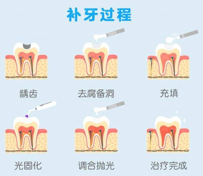 中山大学附属医院口腔医院，补后牙z350要多少钱