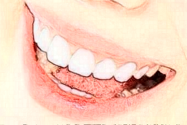 牙齿矫正一般去哪里做?牙齿矫正一定要拔牙齿吗