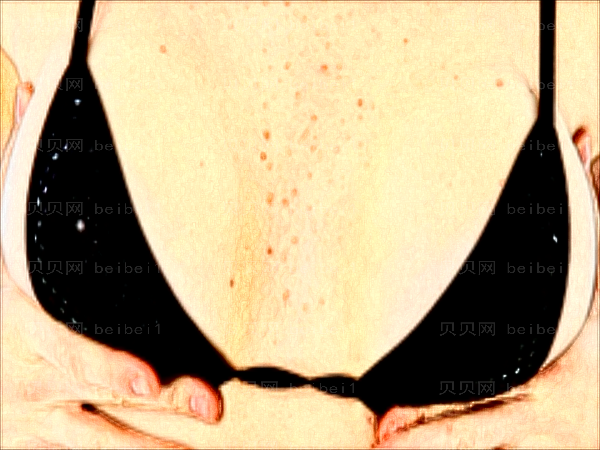 重庆艺星巨乳缩小疼吗?附整形价格一览