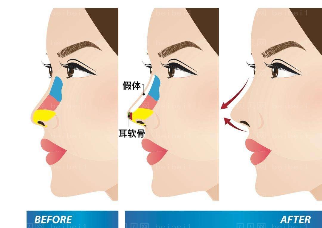 大连医大附二院隆鼻的医生有哪些?赵穆欣反馈怎么样?