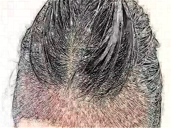 烟台植发哪家医院比较好?医院排名一览