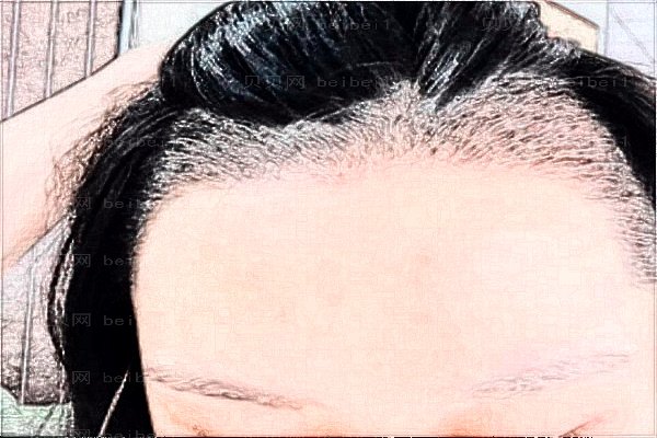 贵州利美康植发价目刷新!技术实力一览