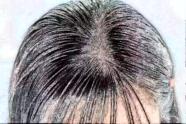 头顶种植头发有风险吗?头顶种植术后怎么养护?