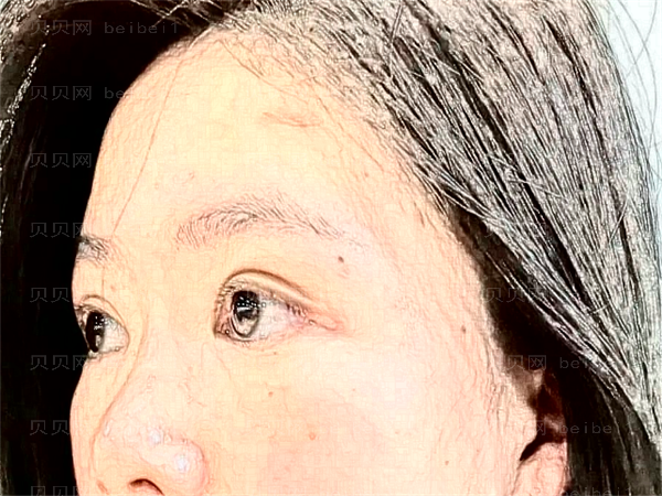 义乌去鱼尾纹整形专家介绍(义乌前五去鱼尾纹医生名单一览)