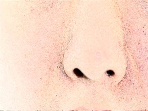 不垫鼻子只缩小鼻头怎么样?缩小鼻头的方法有哪些?