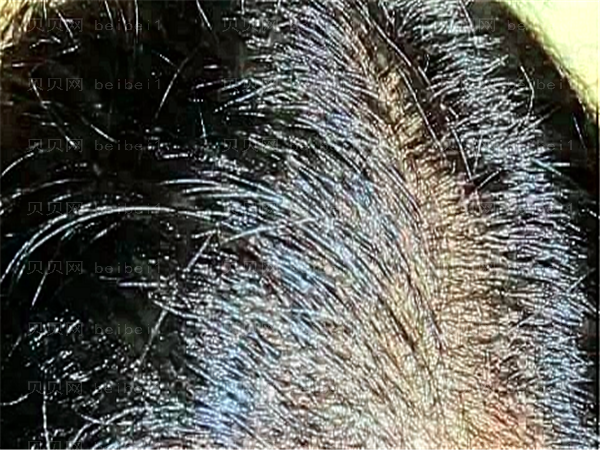 植发多少钱一个毛囊?植发后还会脱发吗?