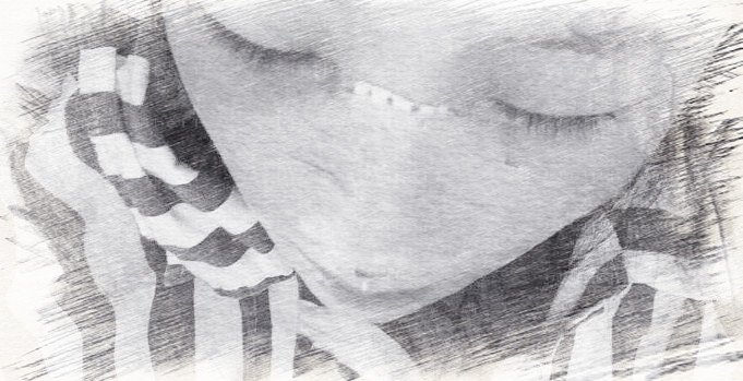 成都西区医院肋软骨隆鼻+歪鼻矫正介绍分享【价格】