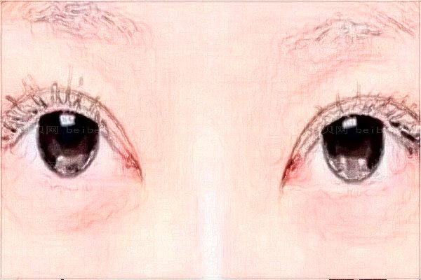 汕头华美开眼角做的好吗(医生名单查看)