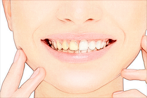 郑州烤瓷牙口腔专家介绍_前七名单查看