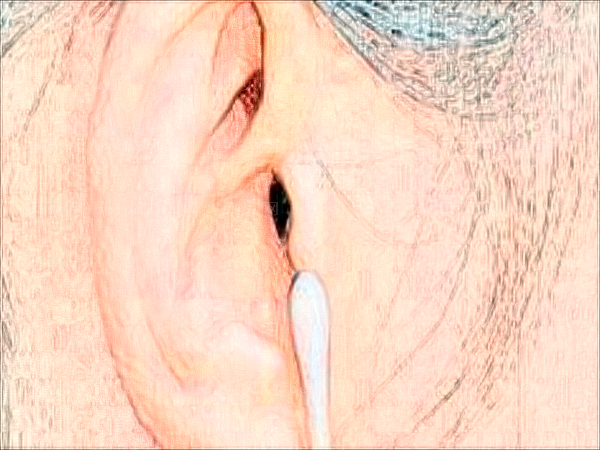 耳再造有几种方法?耳再造有什么并发症