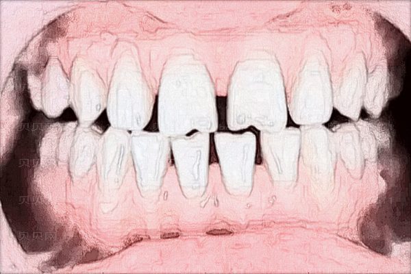 种植牙难受的环节是哪一个步骤?种植牙容易出现的问题?