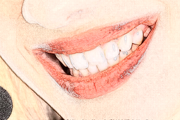 牙齿瓷贴面和树脂贴面区别?牙齿瓷贴面和冷光美白哪个好
