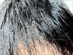 改发际线好吗?改发际线的几种方法