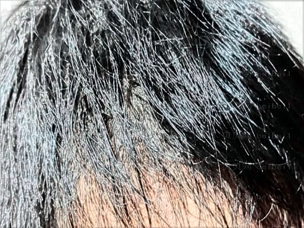 改发际线好吗?改发际线的几种方法