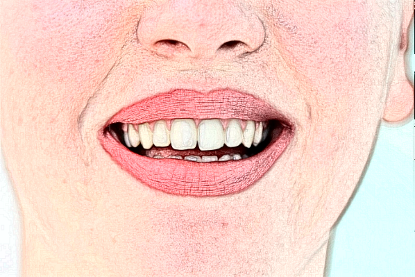 牙齿瓷贴面可以维持多久?牙齿瓷贴面可以洗牙吗