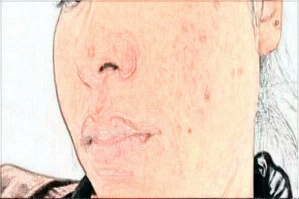 玻尿酸那个医生擅长!医生盘点来看