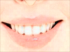 牙齿瓷贴面会透牙齿底色吗?牙齿瓷贴面会影响咬合吗