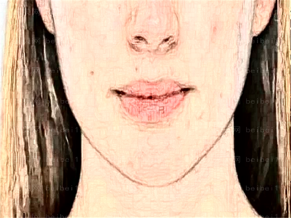 鼻基底抬高后露鼻孔怎么办?鼻基底如何自然变高?