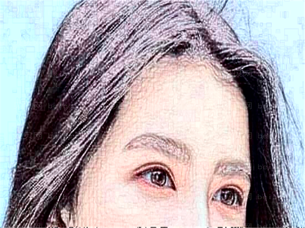 眼睑下至是什么?做眼睑下至风险大吗?