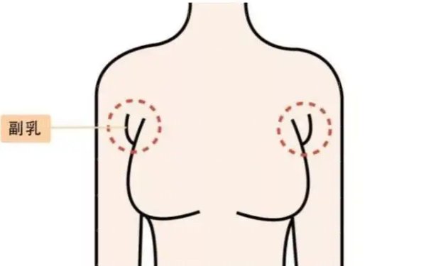 北京艺美硕德去副乳哪位医生做的好?价格需要多少?