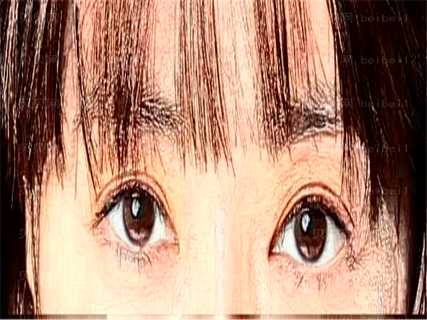 济南普瑞眼科医院近视手术做的怎么样?收费标准更新
