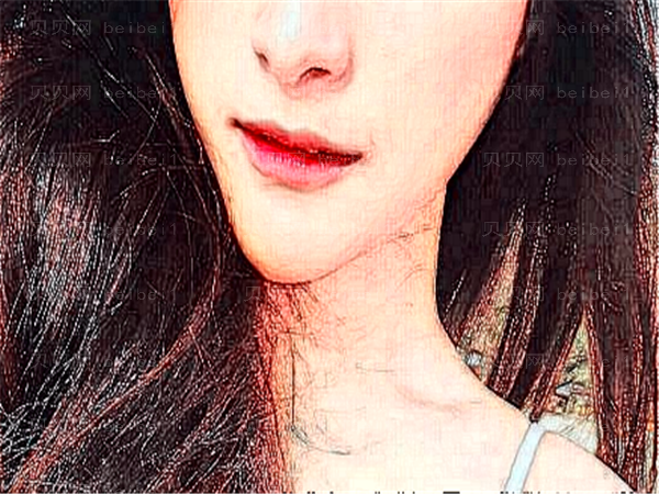 杭州菁华妇儿鼻基底填充做的如何?术前价格参考