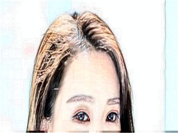 成都蓉雅整形丰太阳穴有风险吗?关注这几位专家就对了!