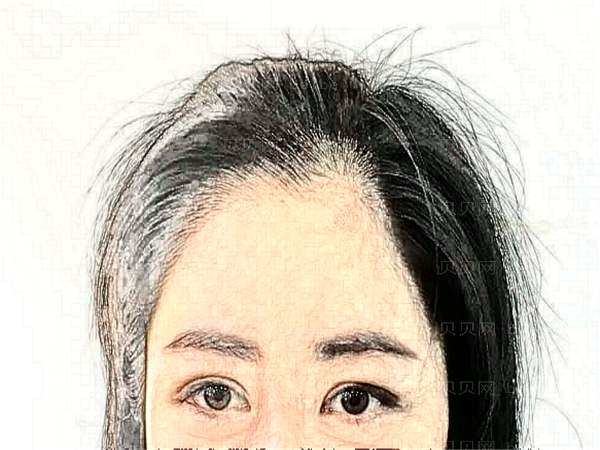 植发原理是什么?后续如何保养?