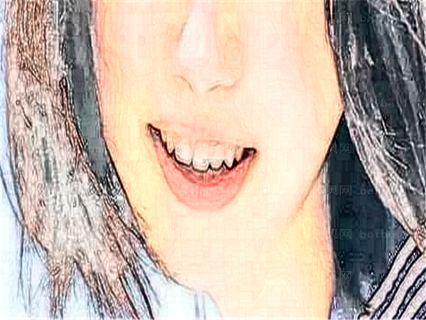 蛀牙形成的原因是什么?应该怎么避免?