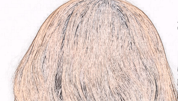 脱发的原因是什么?毛发移植靠谱吗?