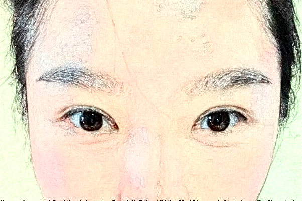 广州希玛眼科医院视力矫正手术医生谁做的好