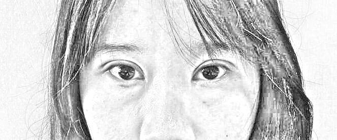 重庆华美整形外科医院 陈凯全切双眼皮·开眼角术后13天介绍分享