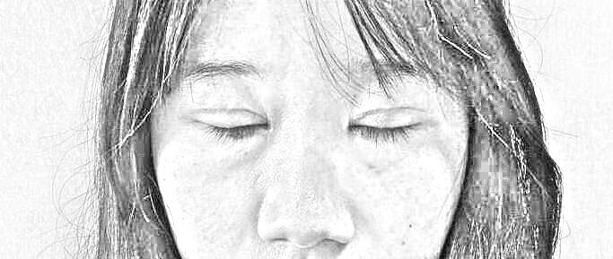 重庆华美整形外科医院 陈凯全切双眼皮·开眼角术后13天介绍分享