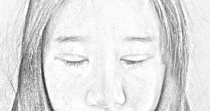重庆华美整形外科医院 陈凯全切双眼皮·开眼角术后13天介绍分享