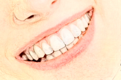 牙齿美白做一次需要多少钱?能维持多久?