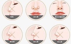 石家庄歪鼻矫正医院介绍前十