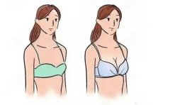 深圳乳房下垂矫正手术医生介绍