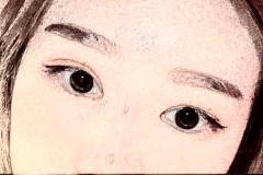 脂肪填充脸部多久消肿?术后注意事项有哪些