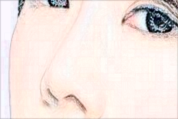 洛阳驼峰鼻矫正哪位医生做得好?
